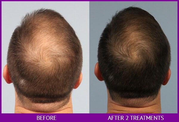 before and after image of PRP