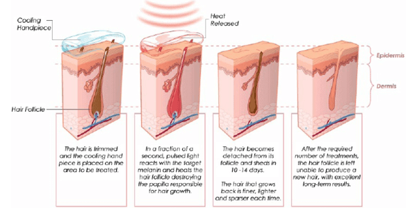 how laser hair removal works