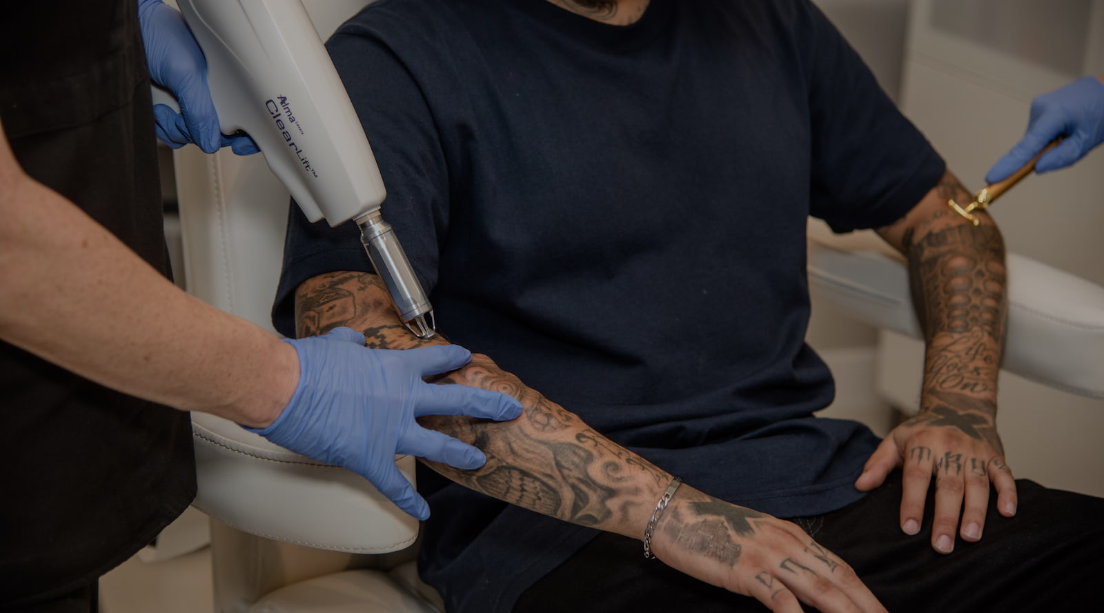 laser tattoo removal at beyond aesthetics