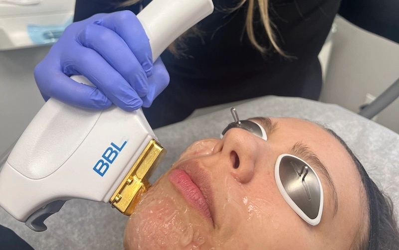 BBL laser treatment, dark spot treatment